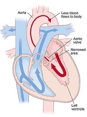 Four-chamber view of heart showing subaortic stenosis. Arrows indicate less blood flowing through aorta.
