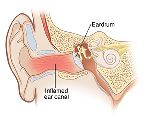 Cross section of ear showing inflammation in ear canal.