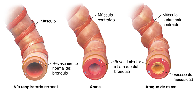 Bronquiolo normal, un bronquiolo apretado con asma y un bronquiolo restringido por exceso de mucosidad durante un ataque de asma.